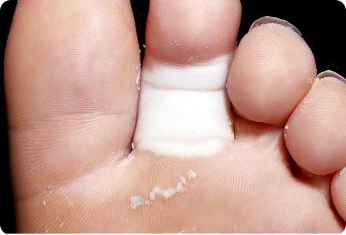 Причини за фрактура на пръстите на краката