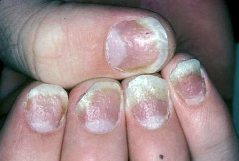 Дупки и вдлъбнатини на повърхността на ноктите