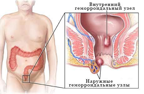 Разпространение на хемороиди