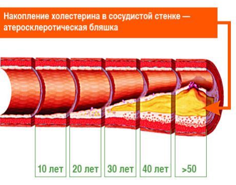 Изяснено е кои атеросклеротични плаки са отговорни за инсулт