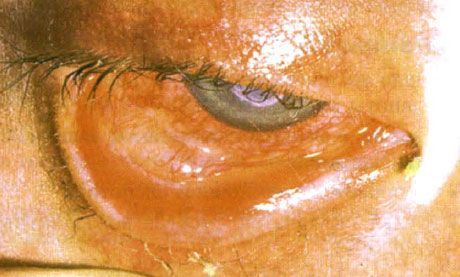 Синдром Стивънс-Джонсън.  Двустранен десквамативен конюнктивит с области на некроза.  Тежък кератит, който причинява появата на белези по роговицата.  Ситуацията е усложнена от добавянето на синдрома на "сухи" очи