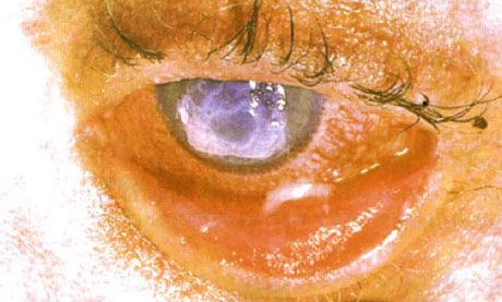 Синдром Стивънс-Джонсън.  Двустранен десквамативен конюнктивит с области на некроза.  Тежък кератит, който причинява появата на белези по роговицата.  Ситуацията е усложнена от добавянето на синдрома на "сухи" очи