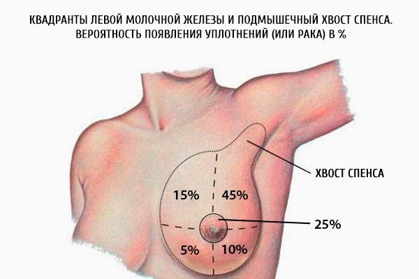 Квадрантите на лявата гърда и аксиларното начало на дупката.  Вероятността от тюлени (или рак) в%