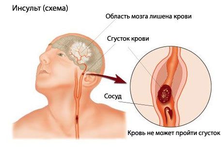 Лесният тест прогнозира фатален удар