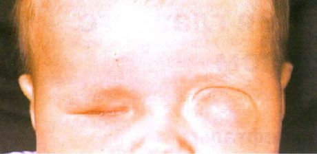 Микрофталмус при съпътстващо формиране на киста (ляво око).  Анофталмус (дясно око).