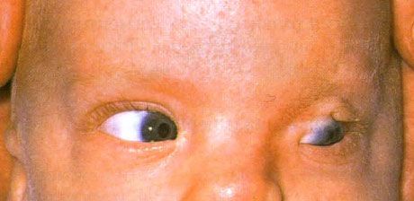 Синдром на Фрейзър.  Непълна криптофталмос на лявото око.