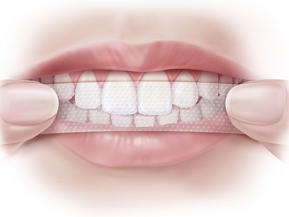 Как да използваме избелващи ленти за зъби?