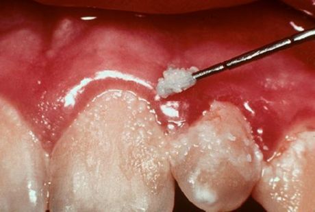 Зъби и гингивити