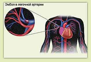 Белодробна емболия и гръдни болки вляво