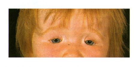 Двустранна колообама на клепачите при дете със синдром на Злат.  Затваряне на прореза за окото вляво