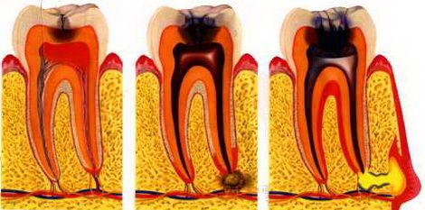 Зъбобол след пълнене 
